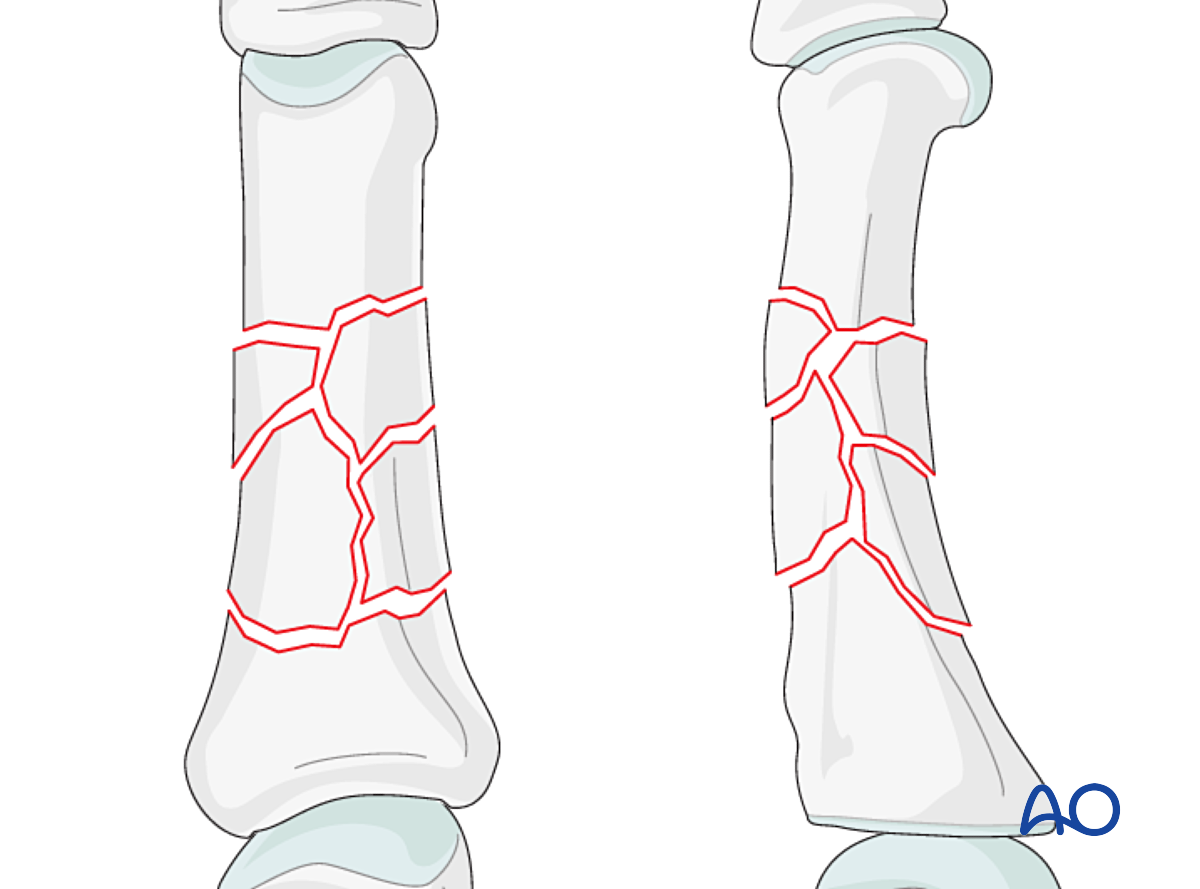 Wedge/multifragmentary Fracture Of The Diaphysis