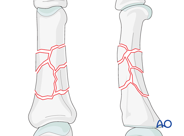 AP and lateral views of a multifragmentary fracture of the diaphyseal phalanx - Proximal phalanx hand