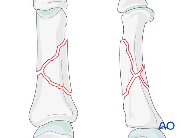 AP and lateral views of a multifragmentary wedge fracture of the diaphyseal phalanx - Proximal phalanx hand