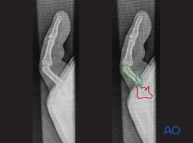 x-ray of a wedge fracture of the 5th proximal phalangeal shaft