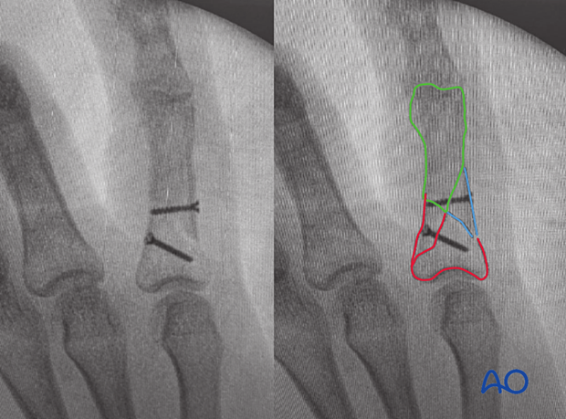 Intraoperative image of lag-screw fixation of a wedge fracture of the 5th proximal phalangeal shaft