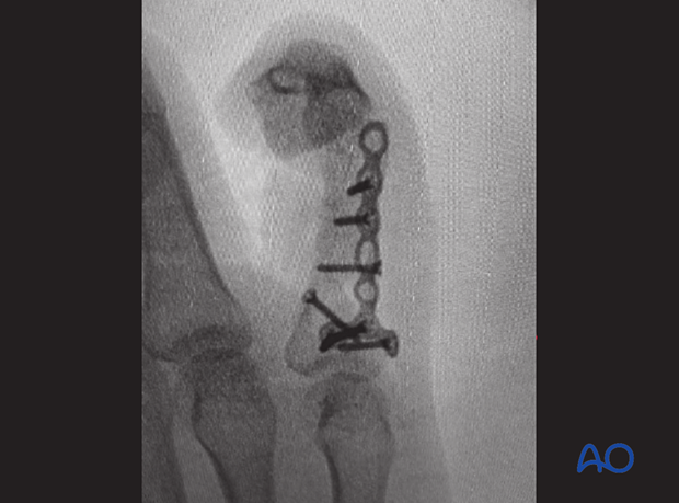 Intraoperative image of lag-screw and plate fixation of a wedge fracture of the 5th proximal phalangeal shaft