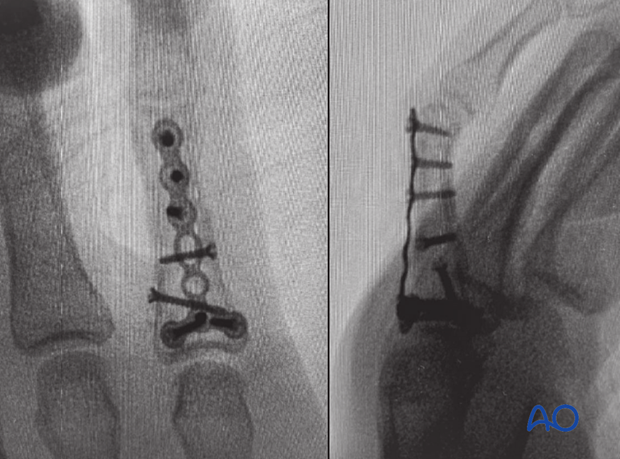 Intraoperative image of lag-screw and plate fixation of a wedge fracture of the 5th proximal phalangeal shaft