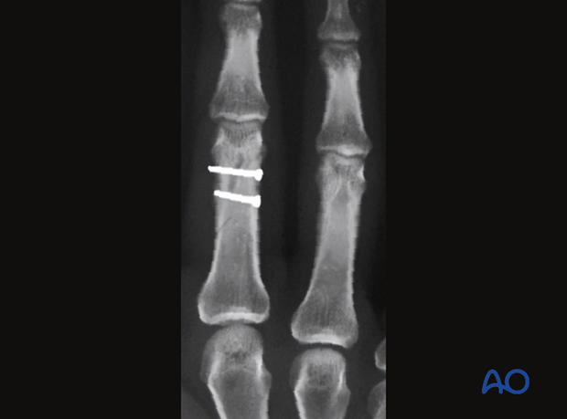 AP x-ray shows fixation with two lag screws of an oblique extraarticular fractures of distal end segment- Proximal phalanx hand