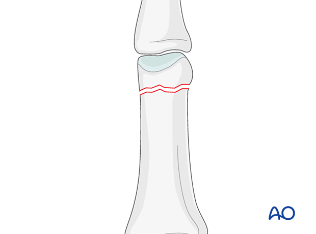 AP view of an transverse extraarticular fracture of the distal end segment- Proximal phalanx hand