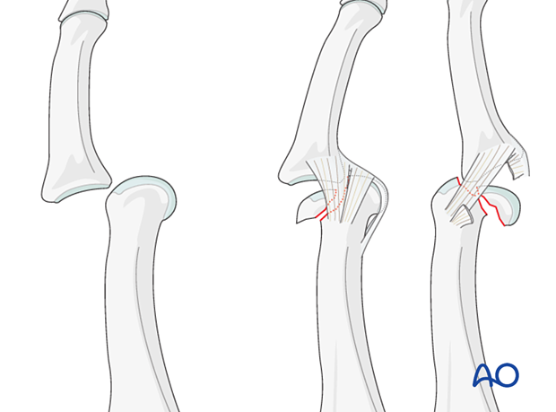 Dislocation of the proximal interphalangeal joint and fracture-dislocations of the proximal interphalangeal joint - proximal phalanx of the hand