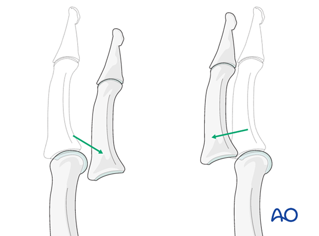 Palmar and dorsal dislocations of the proximal interphalangeal joint