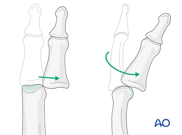 Lateral and lateral-rotatory dislocations of the proximal interphalangeal joint