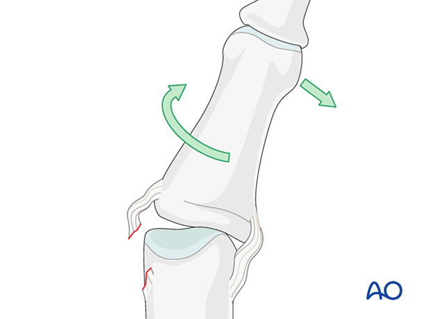 Lateral deviation and rotation as the mechanism of injury for dislocations of the proximal interphalangeal joint