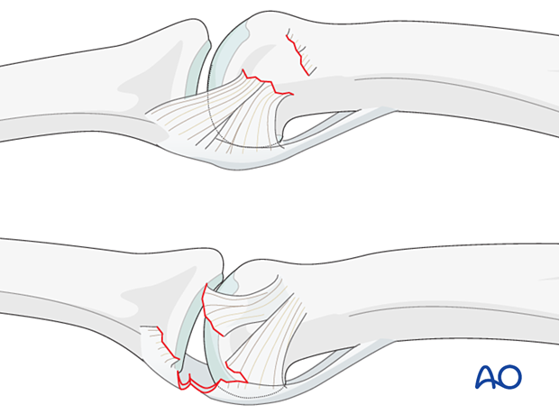 Ligament injuries at the proximal interphalangeal joint