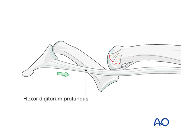 Swan-neck type deformity showing the palmarly dislocated phalanx at the interphalangeal joint with the flexor digitorum profundus pulled the distal interphalangeal joint into flexion