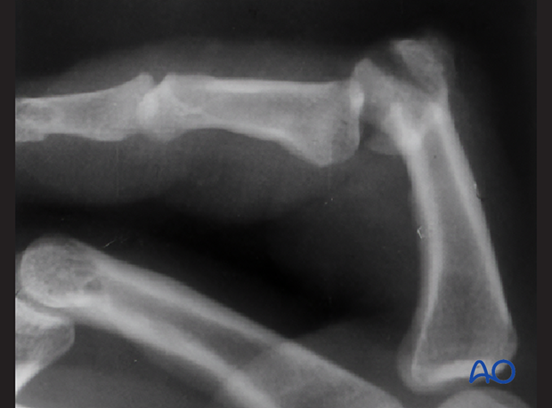 Lateral x-ray of a fracture-dislocation of the proximal interphalangeal joint 