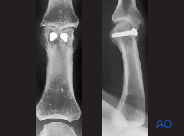 AP and lateral x-rays show fixation with two lag screws of a fracture-dislocation of the proximal interphalangeal joint - proximal phalanx of the hand