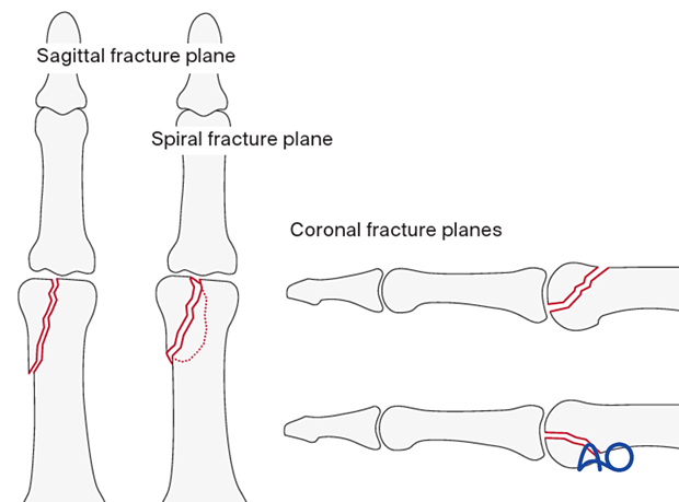 Partial articular fractures of the distal end segment in the sagittal plane or the coronal plane - proximal phalanx of the hand