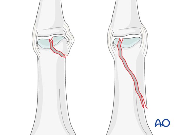 AP view of a partial articular fracture of the distal end segment – proximal phalanx of the hand