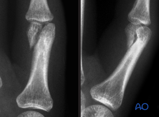 AP and lateral x-rays of a unicondylar partial articular fracture of the 5th proximal phalangeal head - hand