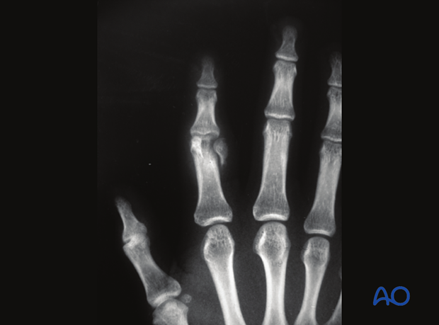 AP x-ray of a unicondylar partial articular fracture of the 2nd proximal phalangeal head - hand