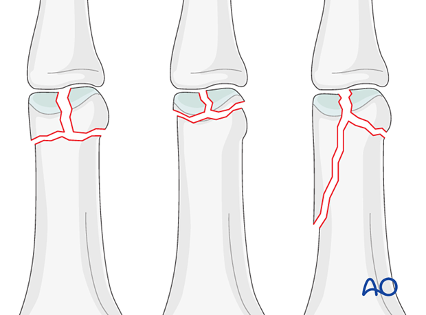 Complete articular fractures of the distal end segment of the proximal phalanx