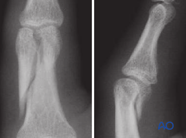 AP and lateral view x-rays of a bicondylar fracture with an extension into the diaphysis – proximal phalanx of the hand