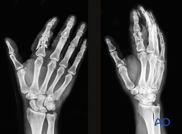 AP and oblique view x-rays of a multifragmentary distal end segment fracture of the second proximal phalanx