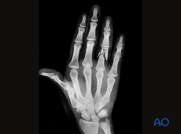 AP view x-ray of a multifragmentary distal end segment fracture of the fourth proximal phalanx