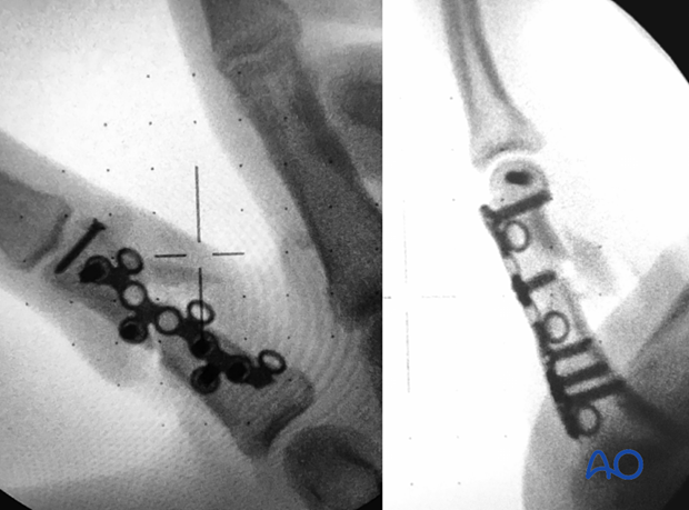 AP and lateral intraoperative view confirming correct screw and plate fixation