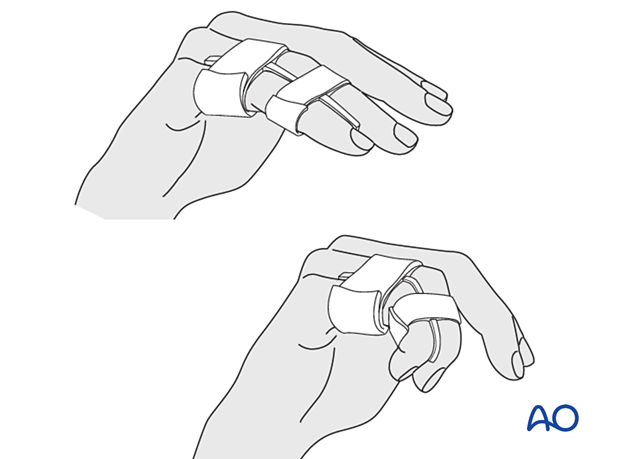 Buddy strapping the injured finger to neighboring finger using gauze pads to prevent direct skin contact and leaving the joints free for mobilization.