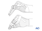 Nonoperative treatment with splinting of a nondisplaced or minimally displaced diaphyseal fracture of the proximal phalanx