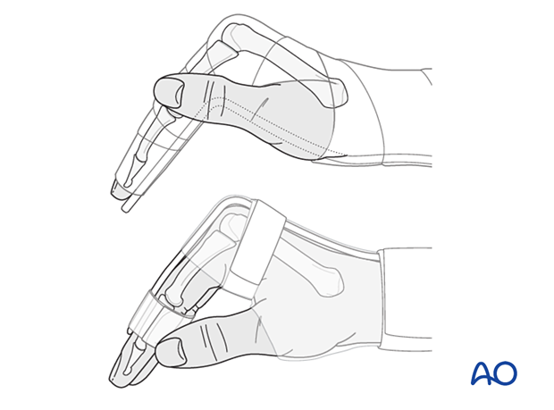 Nonoperative treatment with splinting for undisplaced or minimally displaced diaphyseal and stable extraarticular fracture.