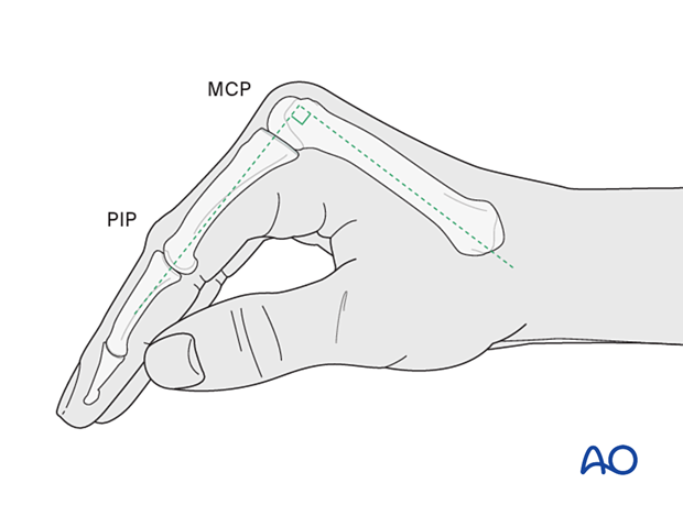 The hand in the intrinsic plus or Edinburgh) position for splinting