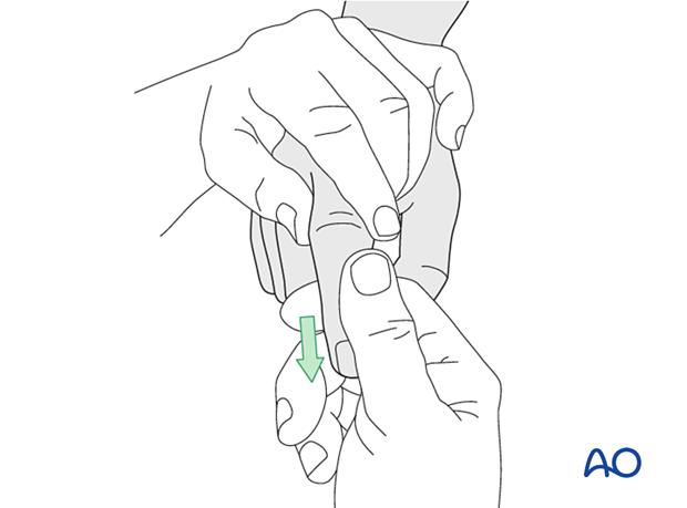 Application of traction to the finger, with the PIP joint in slight flexion to relax the flexor tendons and the lateral band.