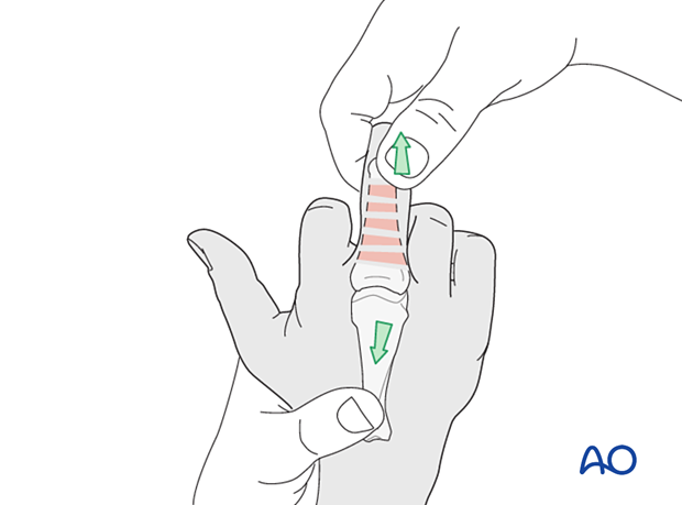 Application of longitudinal traction to the finger and flexion of the metacarpophalangeal joint