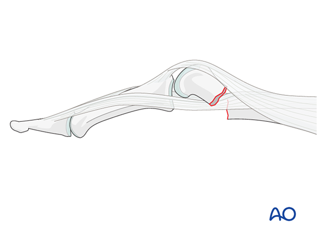 Interposition of the lateral band – of an extraarticular transverse fracture of the proximal phalangeal head – hand.