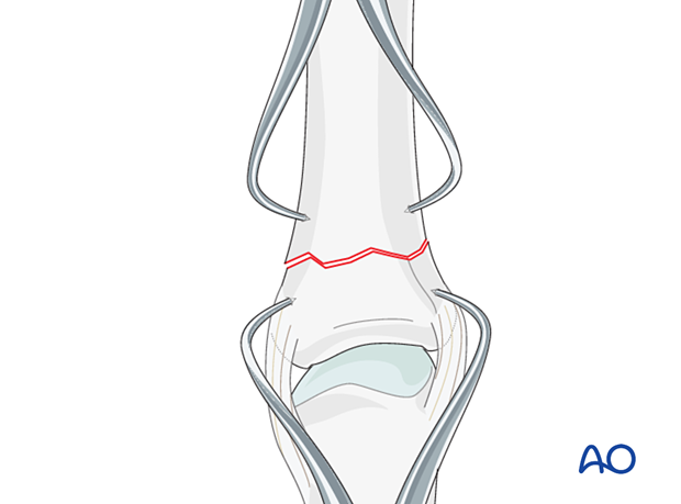 Direct reduction with two pointed-reduction forceps of an extraarticular transverse fracture of the proximal phalangeal base – hand.