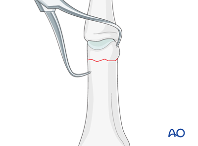 Lateral Compression Plate Compression plating with a lateral plate for Transverse extraarticular ...