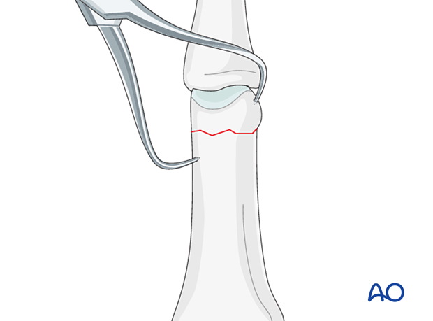 Direct reduction with two pointed-reduction forceps of an extraarticular transverse fracture of the proximal phalangeal head – hand.