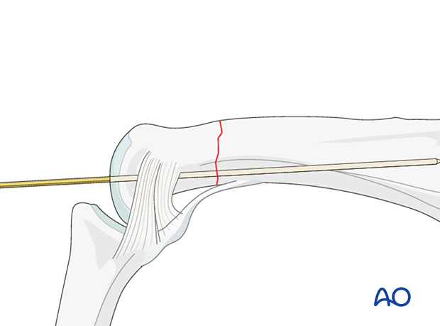 K-wire fixation with a K-wire of an extraarticular transverse fracture of the proximal phalangeal head – hand.