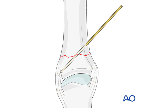 K-wire fixation with a K-wire of an extraarticular transverse fracture of the proximal phalangeal base – hand.