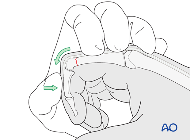 Reduction preliminarily held by an assistant holding the finger in flexion – extraarticular transverse fracture of the proximal phalangeal head – hand.