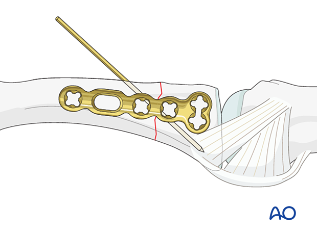 Lateral anatomical plate placement for an extraarticular transverse fracture of the proximal phalangeal base – hand.