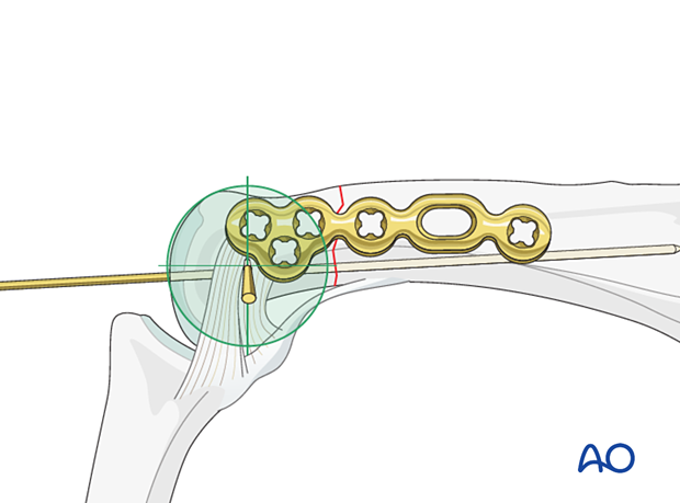 Lateral anatomical plate placement avoiding conflict with the insertion of the collateral ligament – extraarticular transverse fracture of the proximal phalangeal head – hand.