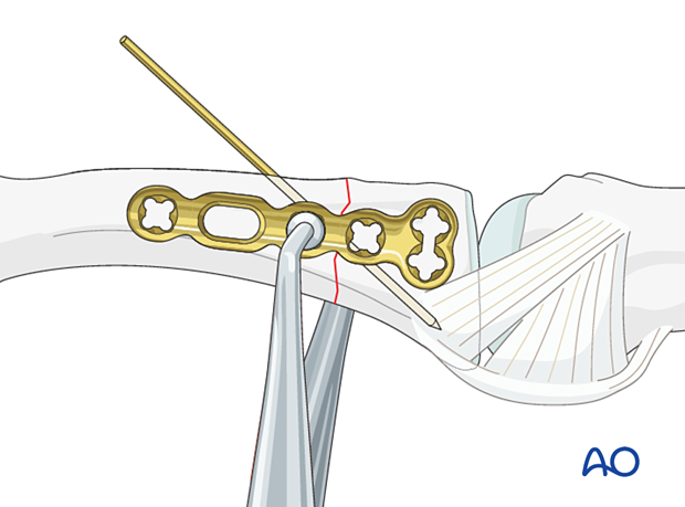 Lateral anatomical plate held in place with an atraumatic forceps – extraarticular transverse fracture of the proximal phalangeal base – hand.