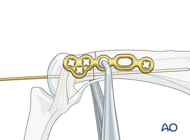 Lateral anatomical plate held in place with an atraumatic forceps – extraarticular transverse fracture of the proximal phalangeal head – hand.