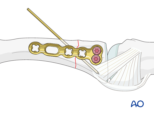 Plate fixed with two locking head screws in the articular block of lateral anatomical plate – extraarticular transverse fracture of the proximal phalangeal base – hand.