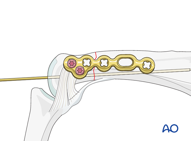 Plate fixed with two locking head screws in the articular block of lateral anatomical plate – extraarticular transverse fracture of the proximal phalangeal head – hand.