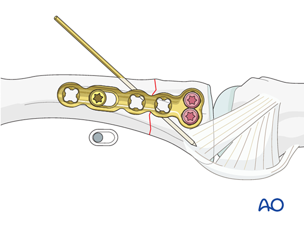 Compression screw inserted in oblong hole of the lateral anatomical plate – extraarticular transverse fracture of the proximal phalangeal base – hand.