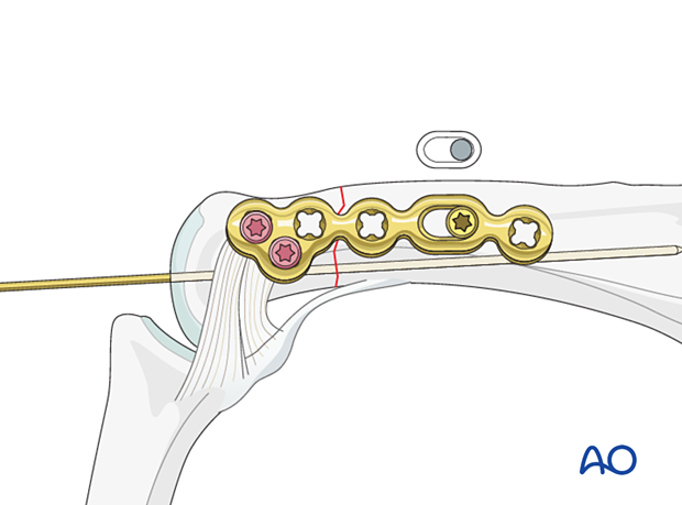 Compression screw inserted in oblong hole of the lateral anatomical plate – extraarticular transverse fracture of the proximal phalangeal head – hand.