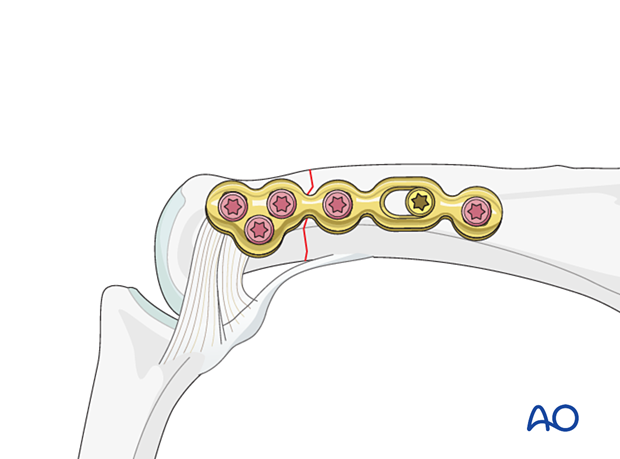 Compression plating with a lateral anatomical plate of an extraarticular transverse fracture of the proximal phalangeal head – hand.