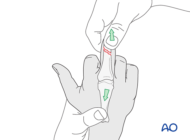 Indirect reduction by application of traction and lateral pressure exerted at the site of maximal displacement – extraarticular oblique fracture of the proximal phalangeal head – hand.