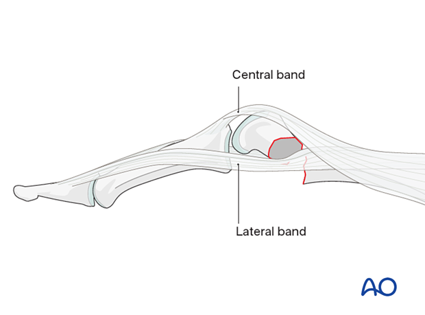 Interposition of the lateral band at an extraarticular oblique fracture of the proximal phalangeal head – hand